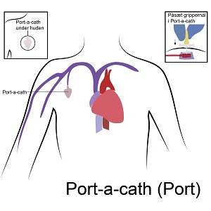 Port-a-cath (Port)