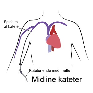 Midline kateter